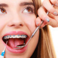Πώς να ισιώσετε τα δόντια χωρίς σιδεράκια