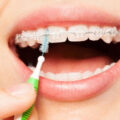 Σύνθετα οδοντικά σφραγίσματα – Όλα όσα πρέπει να γνωρίζετε