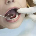Τι είναι οι λευκές κηλίδες στα δόντια;