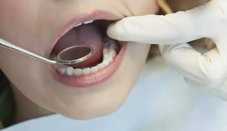 Τι είναι οι λευκές κηλίδες στα δόντια;
