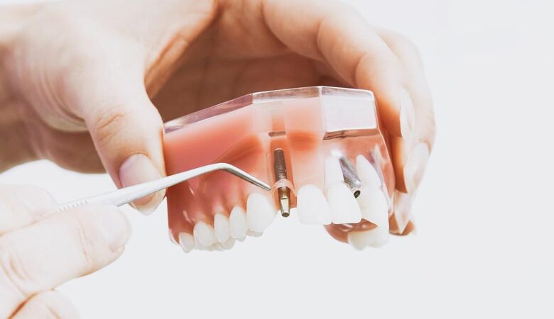 Τι είναι τα οδοντικά εμφυτεύματα;
