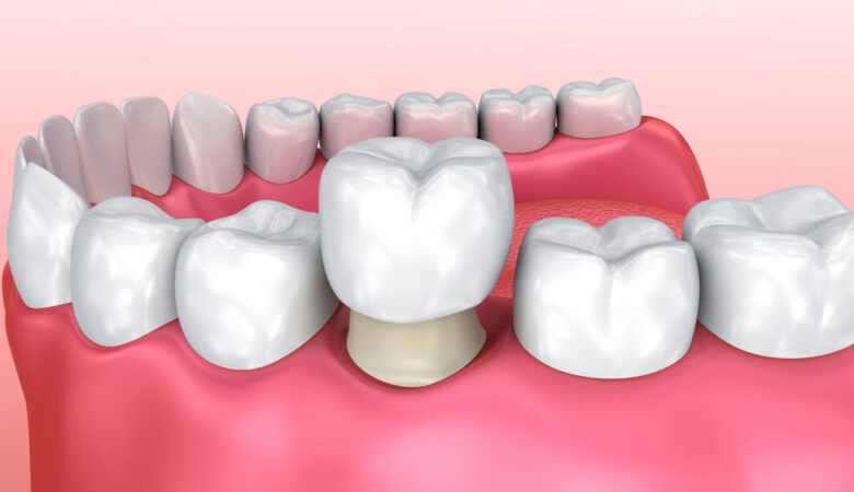 Τι είναι το Συγκόλληση δοντιών και το χρειάζεστε;